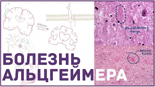 Болезнь Альцгеймера - причины, симптомы, патогенез, лечение
