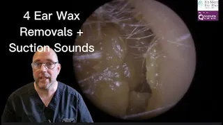 4 Ear Wax Removals & Suction Sounds! - Episode 57 #earwaxremoval