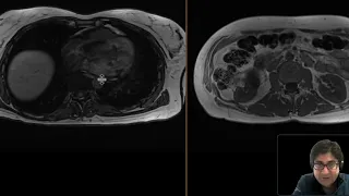 Renal angiomyolipoma