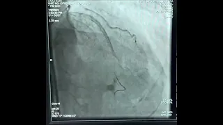 Case 2 IVUS Coronary artery perforation, ping pong technique, covered stent