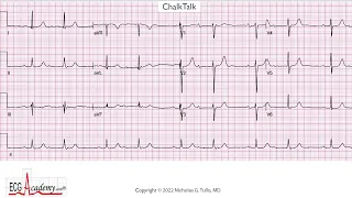 Learn ECG Arrhythmia Analysis – Read Complex EKGs with ChalkTalk #536
