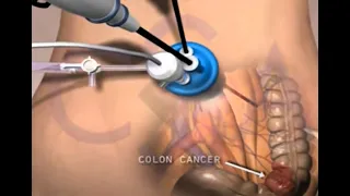 Single Incision Laparoscopic Surgery - SILS 3D Animation