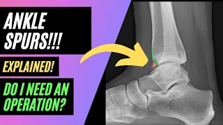 Ankle Spurs! A Common Cause of Pain At The Front of The Ankle!