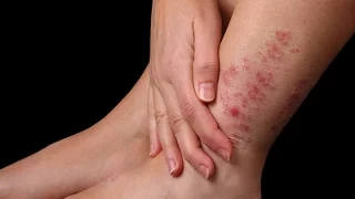 Как быстро вылечить кожное заболевание