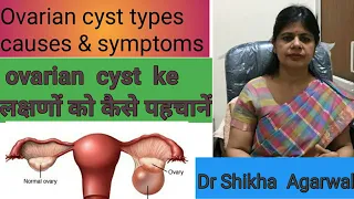 Ovarian cyst /अंडाशय की गांठ/ Causes Symptoms /PCOD/ Drhome/ hindi