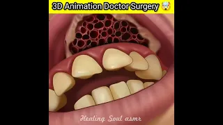 3D Animation Doctor infection surgery 🤯 ? #shorts #viral