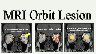 MRI Orbit