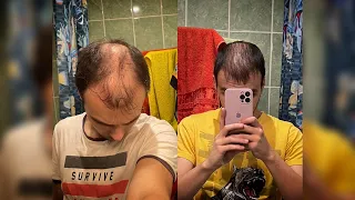 Результат пересадки волос 4 месяца, 5100 графтов