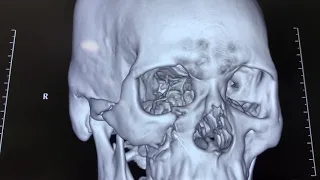 Scarless technique mastered by dr sunil richardson to treat orbital and eye socket fractures