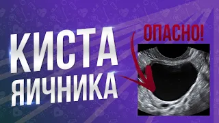 ОПАСНО! КИСТА ЯИЧНИКА! Чем грозит если не лечить?