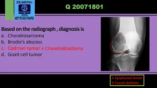 Differentiating epiphyseal lesions- Chondroblastoma vs Giant cell tumor