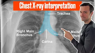 Chest X ray interpretation (in 10 minutes) for beginners🔥🔥🔥 #chestxray #cxr