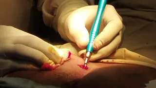 Laser Pilonidoplasty -Pilonidal sinus Laser  treatment