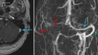 Blood clots, stroke now side effects of COVID-19