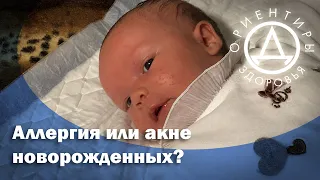Аллергия или акне новорожденных?