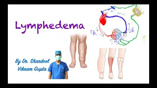 Lymphedema for MBBS/ MS Surgery medical students