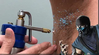 Armpits vs Liquid Nitrogen - Skin Tag Eradication!