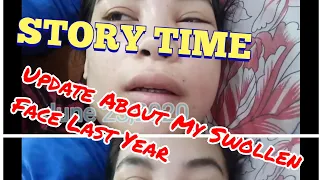 Update To My Swollen Face/storytime