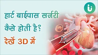 हार्ट बाईपास सर्जरी क्या है और कैसे की जाती है? देखें 3D में - What is heart bypass surgery in hindi