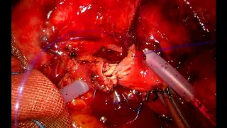 Uniportal VATS double sleeve lobectomy (vascular anastomosis)