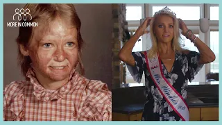 From Burn Victim to Beauty Contestant | More in Common