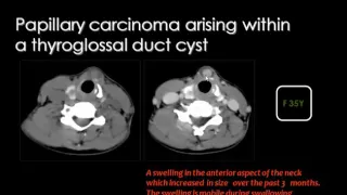 Imaging of Infra hyoid neck I   DRE 13   Dr Mamdouh Mahfouz