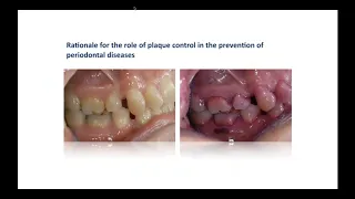 BSP WEBINAR - Periodontal disease management by Prof. Nicola West