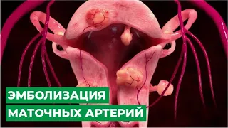 Эмболизация маточных артерий