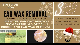 IMPACTED EAR WAX REMOVAL FROM EARDRUM & DRY SKIN RIBBON AND EAR WAX REMOVAL - EP404