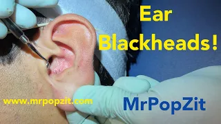 Ear Blackheads and more! Tricky extractions deep in the ear. Many waxy comedones removed.