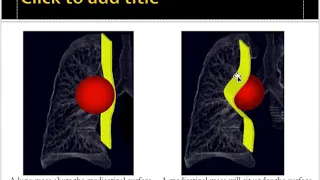 Mediastinal masses approach