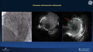 Coronary protection in transcatheter aortic valve replacement: when, how & critical decision making