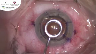 Management of High Astigmatism after Corneal Transplant