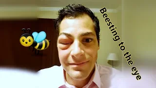 Bee sting to the eye and syncing audio