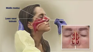 How to Obtain a Nasal Mid-turbinate (NMT) Swab for COVID-19