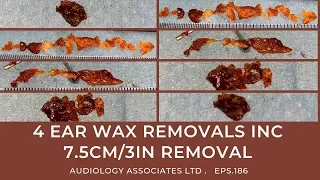 4 EAR WAX REMOVALS INC 7.5CM/3IN REMOVAL - EP186