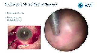 Laser Endoscopy - Endophthalmitis Bleb Infection