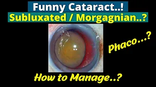 Challenging Cataract. Planning & Implementation in dealing with this complex Case - Dr Deepak Megur