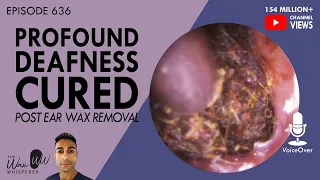 636 - Profound Deafness Cured Post Ear Wax Removal