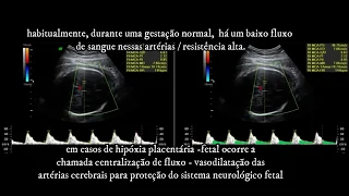 DOPPLER OBSTÉTRICA FETAL - ARTÉRIA CEREBRAL MÉDIA - CLÍNICA SARRAFF CURITIBA - PARTE 4