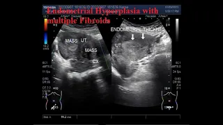 Endometrial Hyperplasia with multiple Fibroids.