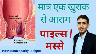 मस्से | पाइल्स | बवासीर का परमानेंट इलाज | Best Homeopathic Medicine For piles | Piles Treatment