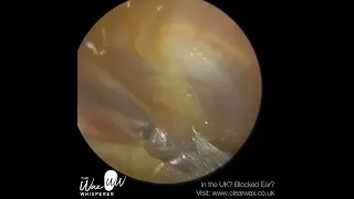 1,098   Dead Skin Peel off Eardrum and Ear Canal​ 000