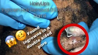 A DOUBLE SIDED PORE 😱 | Ingrown Hair Removal & Extractions Part 14 | Neck & Beard Area