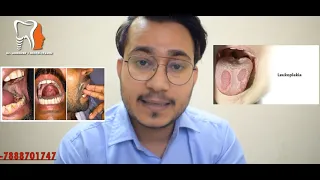 OSMF AND LEUKOPLAKIA- DR.CHANDER UDHEY- WHITE SPOTS AND LESIONS- RED SPOTS ON ORAL MUCOSA IN HINDI