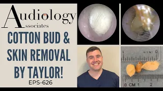 COTTON BUD & SKIN REMOVAL BY TAYLOR - EP626