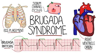 Brugada Syndrome Explained  (Includes ECG) - "Sudden Unexplained Nocturnal  Death Syndrome"