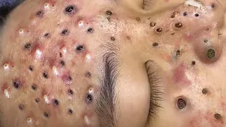 Blackhead Removal With Sac Dep Spa @10007084