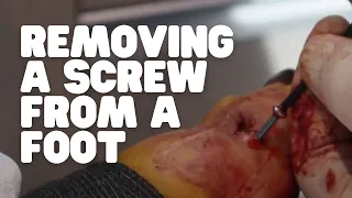 REMOVING A SCREW FROM A FOOT!!!!!! (Part Two)