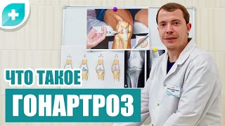 Что такое гонартроз.